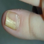 Як позбутись грибка нігтів народними засобами