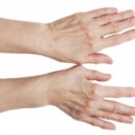 Як лікувати артрит рук